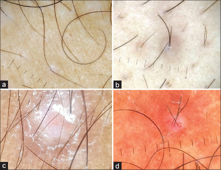 A Clinical, Dermoscopic, and Histopathological Study of Follicular Psoriasis.