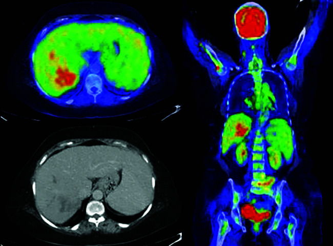 Detection of Primary Hepatocellular Carcinoma on <sup>18</sup>F-Fluorodeoxyglucose Positron Emission Tomography-computed Tomography.