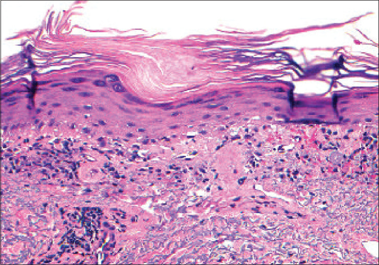 Photodistributed Lichenoid Eruption with Alopecia: A Unique Presentation of Graham-Little-Piccardi-Lasseur Syndrome.