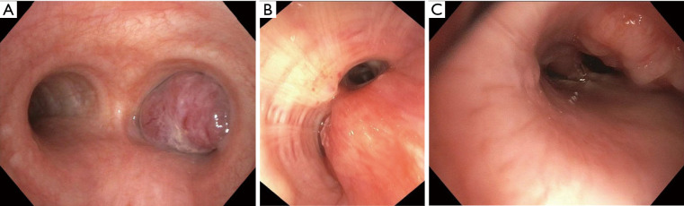 Overview of malignant central airway obstruction.