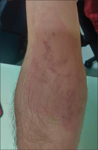 Allergic reaction to heparin gel - Adding agony to blood donor.