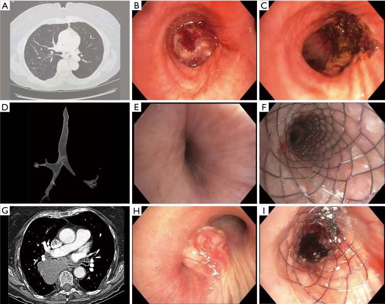 Overview of malignant central airway obstruction.