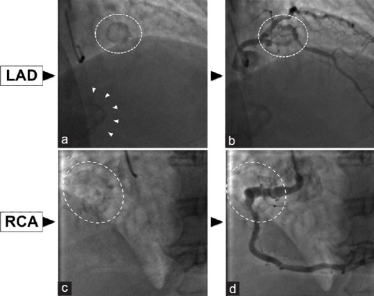 A Multimodality Imaging for Definition and Treatment Selection of Multiple Coronary Aneurysms: A Case Report and Review of the Literature.