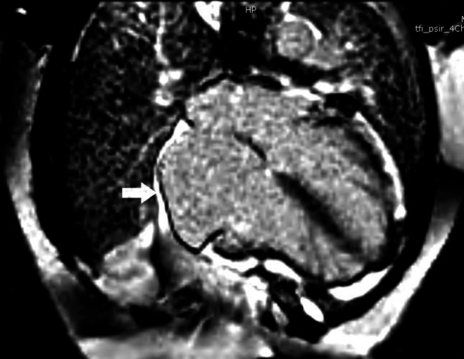 A Review of the Surgical Treatment for Constrictive Pericarditis.