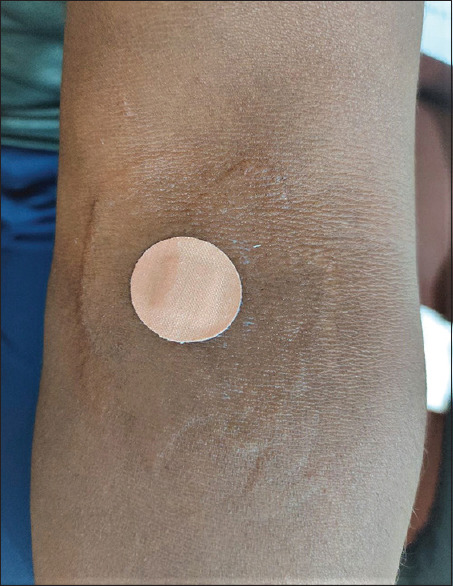 Allergic reaction to heparin gel - Adding agony to blood donor.