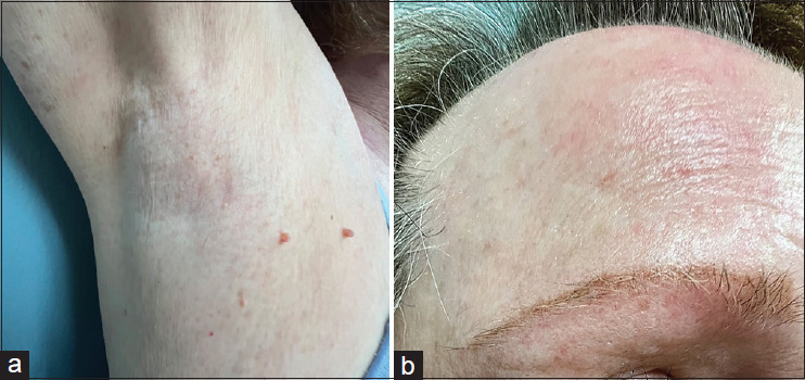Photodistributed Lichenoid Eruption with Alopecia: A Unique Presentation of Graham-Little-Piccardi-Lasseur Syndrome.