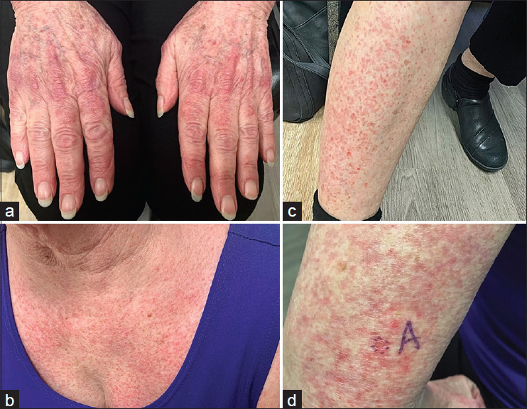 Photodistributed Lichenoid Eruption with Alopecia: A Unique Presentation of Graham-Little-Piccardi-Lasseur Syndrome.