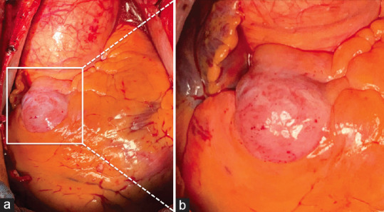 A Multimodality Imaging for Definition and Treatment Selection of Multiple Coronary Aneurysms: A Case Report and Review of the Literature.