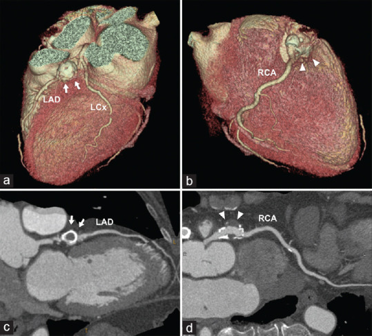 A Multimodality Imaging for Definition and Treatment Selection of Multiple Coronary Aneurysms: A Case Report and Review of the Literature.
