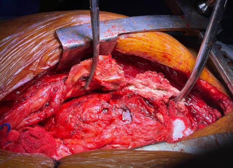 A Review of the Surgical Treatment for Constrictive Pericarditis.