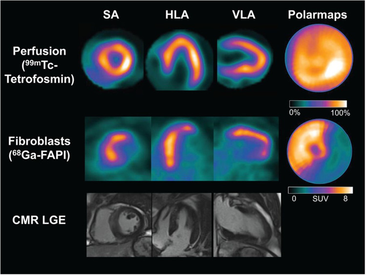Gallium-68 fibroblast activation protein inhibitor positron emission tomography in cardiovascular disease.
