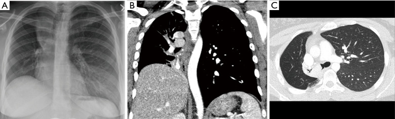 Overview of malignant central airway obstruction.