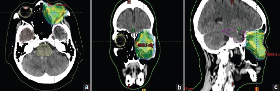 Primary orbital squamous cell carcinoma treated with definitive radiotherapy.