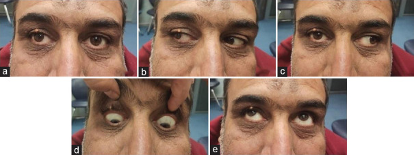 Internuclear ophthalmoplegia following radial artery cardiac catheterization approach: An unusual presentation.