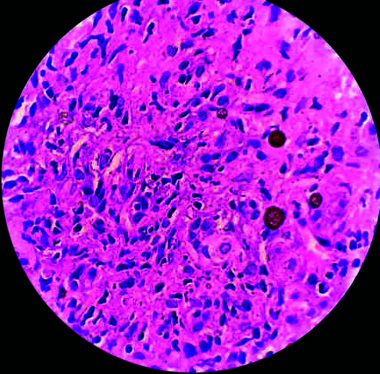 Case of Autoimmune Hepatitis.