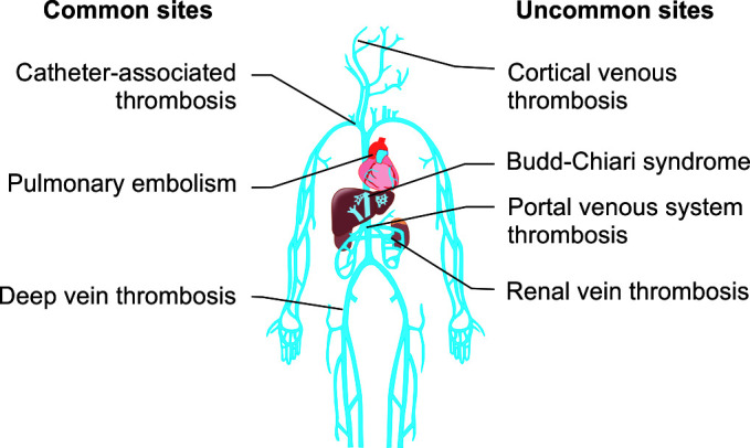 Standard and Extended Thromboprophylaxis in Patients with Inflammatory Bowel Disease: A Literature Review.