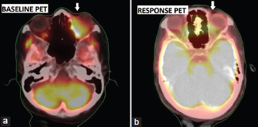 Primary orbital squamous cell carcinoma treated with definitive radiotherapy.