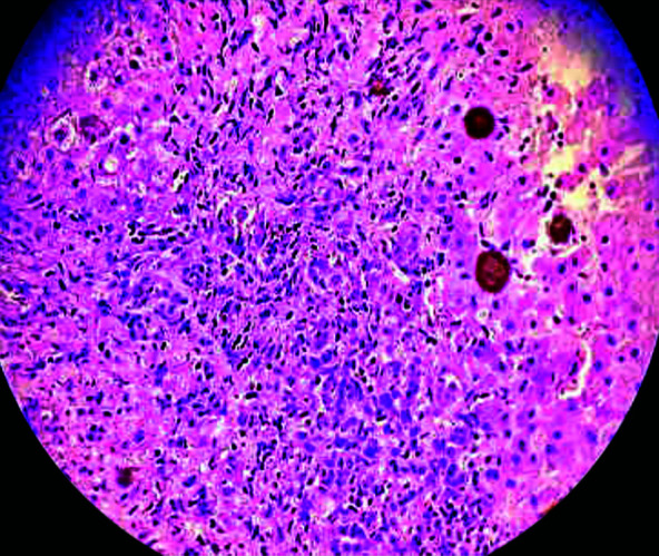 Case of Autoimmune Hepatitis.