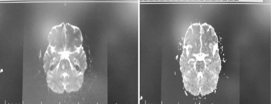 Internuclear ophthalmoplegia following radial artery cardiac catheterization approach: An unusual presentation.