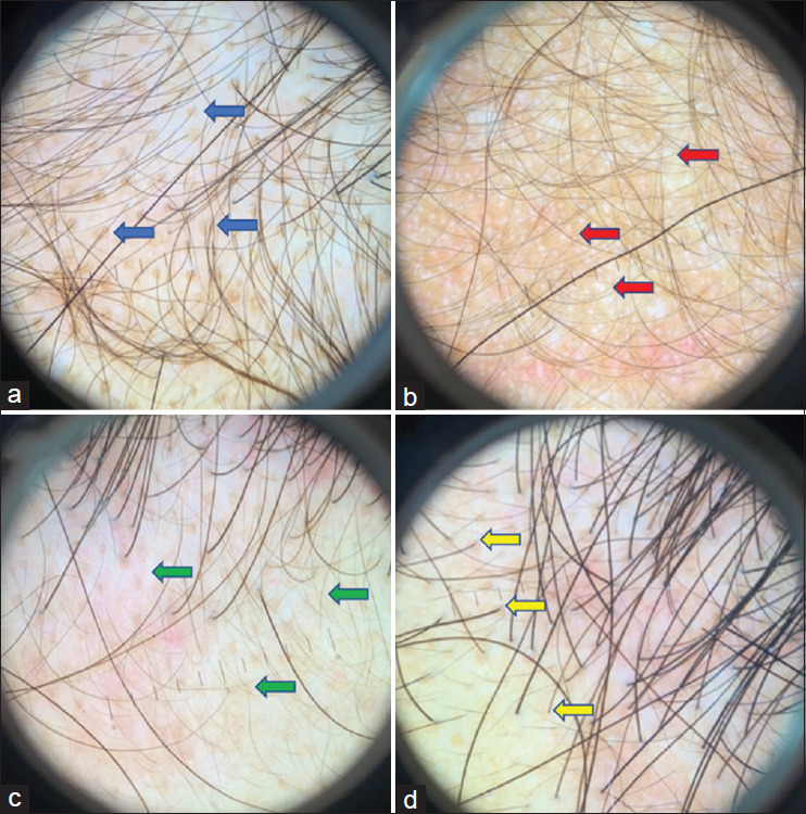 Trichoscopy Features of Indonesian Males with Androgenetic Alopecia in Association with Disease Severity.