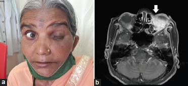 Primary orbital squamous cell carcinoma treated with definitive radiotherapy.