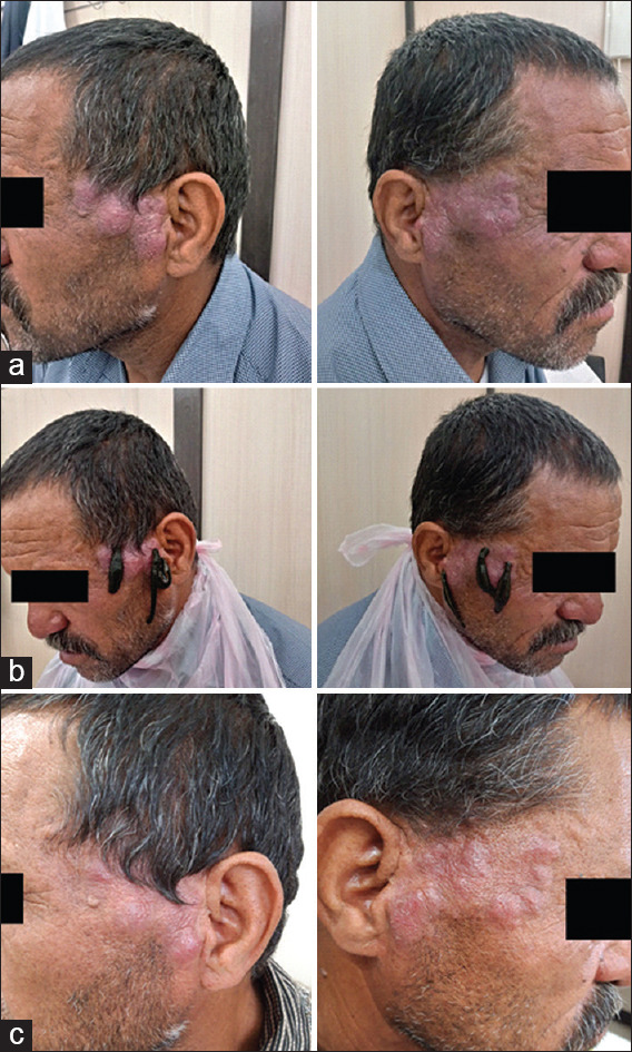 Successful maintenance treatment of a patient with chronic dermatitis with leech therapy.
