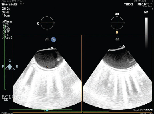A Case of Type B Aortic Dissection: The Role of Transesophageal Ultrasound Guidance in Thoracic Endovascular Aortic Repair.