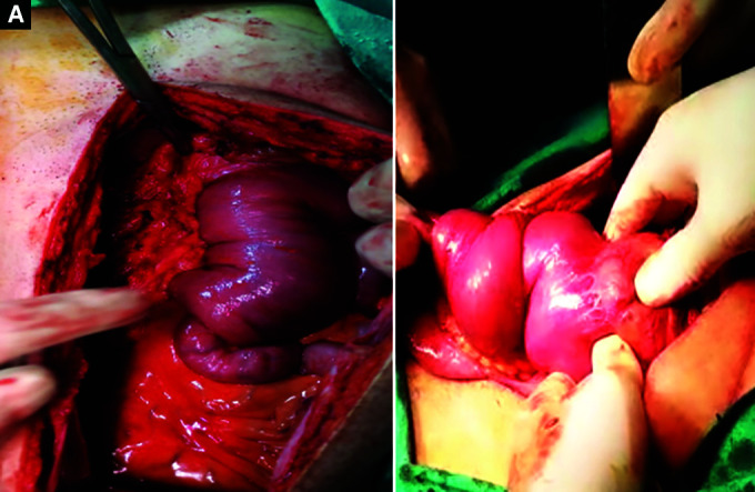 Jejunogastric Intussusception: A Rare Case Report Study.