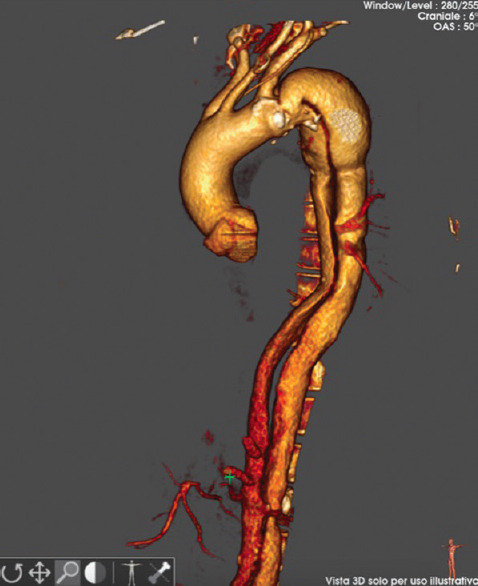 A Case of Type B Aortic Dissection: The Role of Transesophageal Ultrasound Guidance in Thoracic Endovascular Aortic Repair.