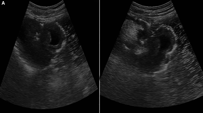 Jejunogastric Intussusception: A Rare Case Report Study.
