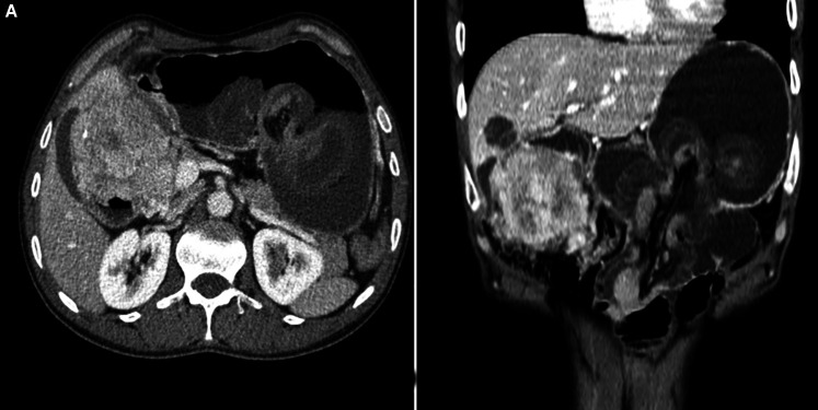 Jejunogastric Intussusception: A Rare Case Report Study.
