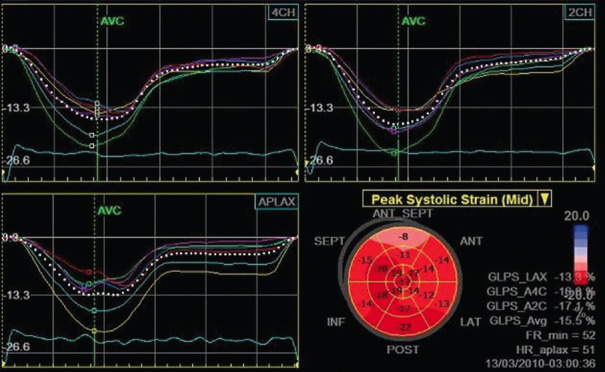 Impact of Coronary Microvascular Dysfunction on Myocardial Strain in Patients with Heart Failure and Preserved Ejection Fraction.