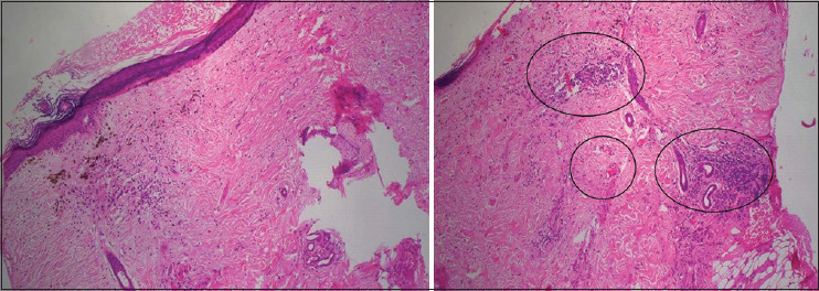 Halting the Progression of Cicatricial Alopecia with Injectable Platelet-Rich Fibrin.