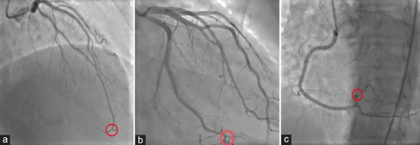Impact of Coronary Microvascular Dysfunction on Myocardial Strain in Patients with Heart Failure and Preserved Ejection Fraction.