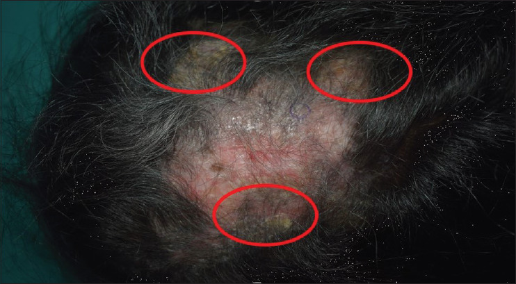 Halting the Progression of Cicatricial Alopecia with Injectable Platelet-Rich Fibrin.