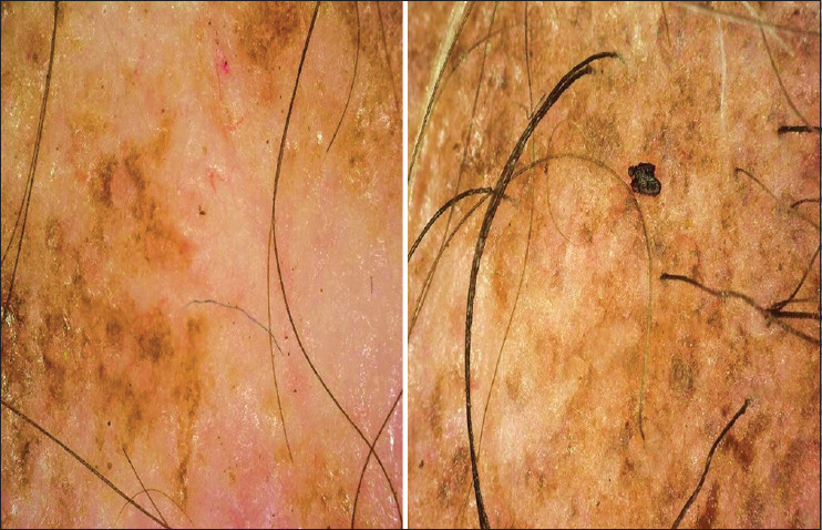 Halting the Progression of Cicatricial Alopecia with Injectable Platelet-Rich Fibrin.