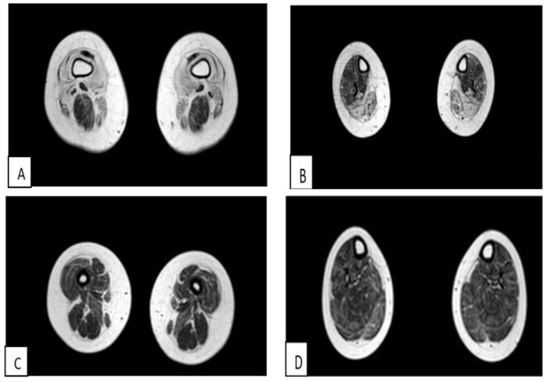 Limb-Girdle Muscular Dystrophy D2 TNPO3-Related: A Quality of Life Study.