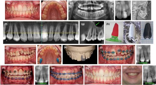 Anterior tooth autotransplantation: a case series