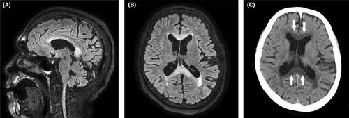 A patient with Marchiafava–Bignami disease type A transported by ambulance with impaired consciousness and malnutrition was successfully treated after early diagnosis by MRI