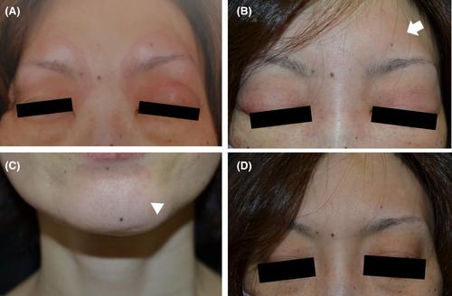 Angioedema-like eyelid edema following the second NVX-CoV2373 COVID-19 vaccination