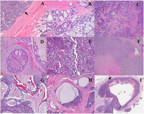 The evolving landscape of salivary gland tumors