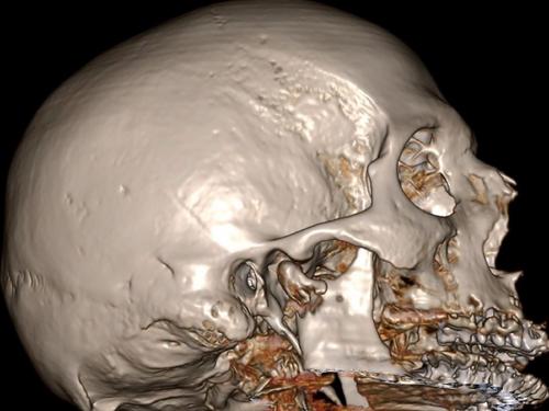 Mandibular metastasis of pulmonary adenocarcinoma: How unexpected could it be?