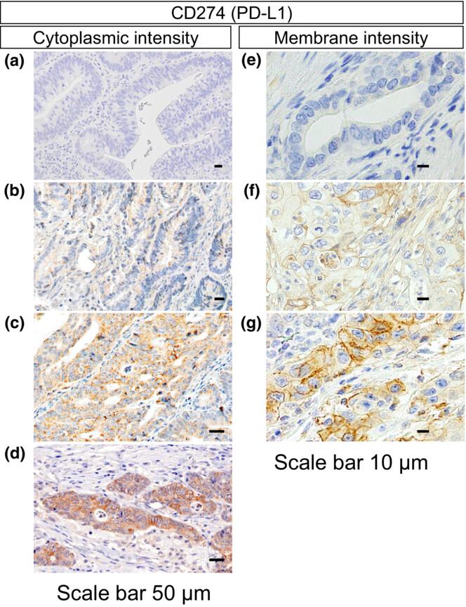 Inverse relationship between Fusobacterium nucleatum amount and tumor CD274 (PD-L1) expression in colorectal carcinoma