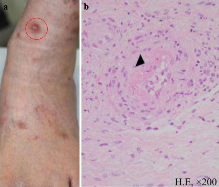 A Changing Anti-Neutrophil Cytoplasmic Antibody Profile in a Patient With a Diagnosis of Eosinophilic Granulomatosis With Polyangiitis.