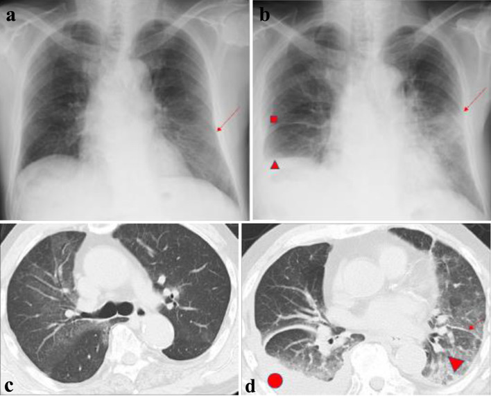 A Changing Anti-Neutrophil Cytoplasmic Antibody Profile in a Patient With a Diagnosis of Eosinophilic Granulomatosis With Polyangiitis.