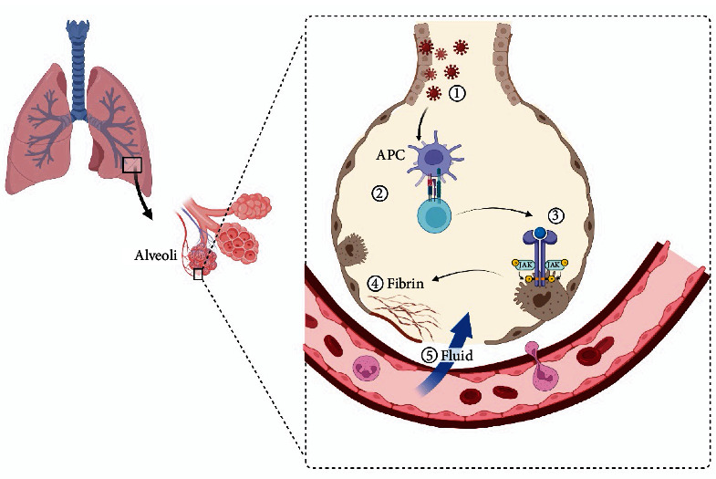 The Important Role of Interleukin-2 in COVID-19.