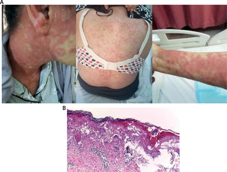 Rowell syndrome.