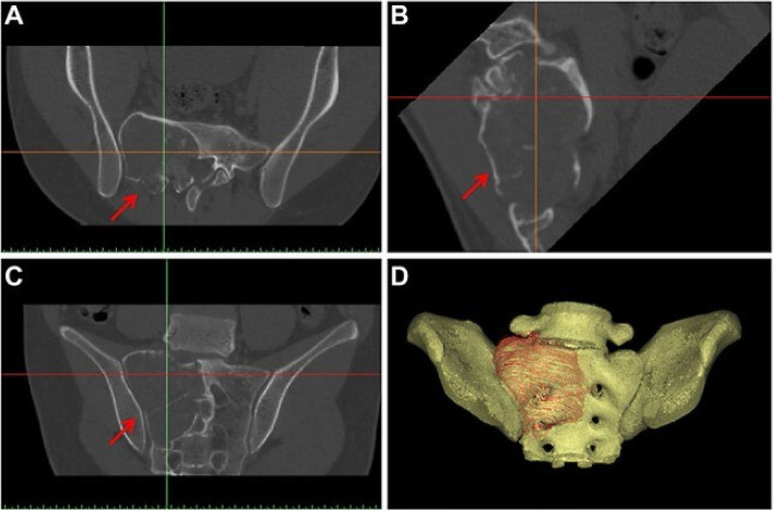 Recent advances in 3D printing of biodegradable metals for orthopaedic applications.