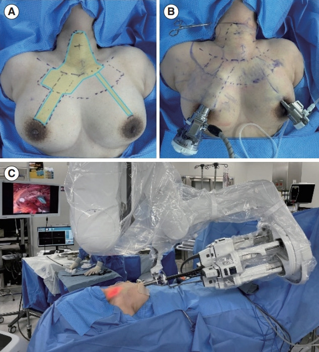 First Experience of Single-Port Robotic Areolar Approach Thyroidectomy.