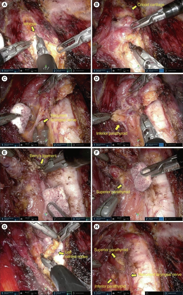 First Experience of Single-Port Robotic Areolar Approach Thyroidectomy.